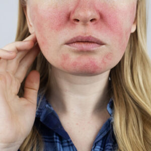 PROTOCOLO ROSACEA