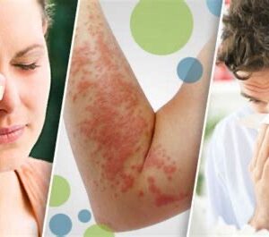 PROTOCOLO ALERGIA - SINTOMAS RESPIRATORIOS Y DE PIEL