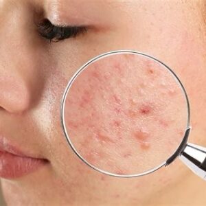 PROTOCOLO ACNE E IMPERFECCIONED