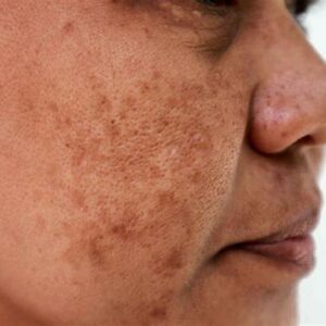 Protocolo manchas solares edad