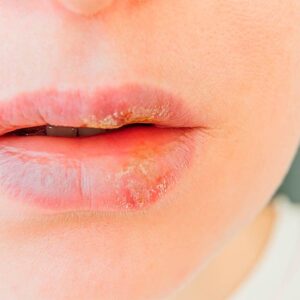 PROTOCOLO HERPES