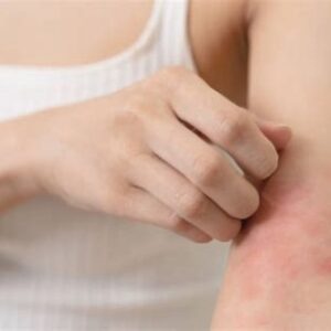 PROTOCOLO IRRITACIÓN VERANO